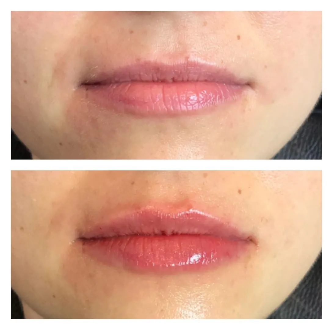 Natural, rested-looking lip enhancement result